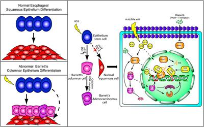 The Oxidative Damage and Inflammation Mechanisms in GERD-Induced Barrett’s Esophagus